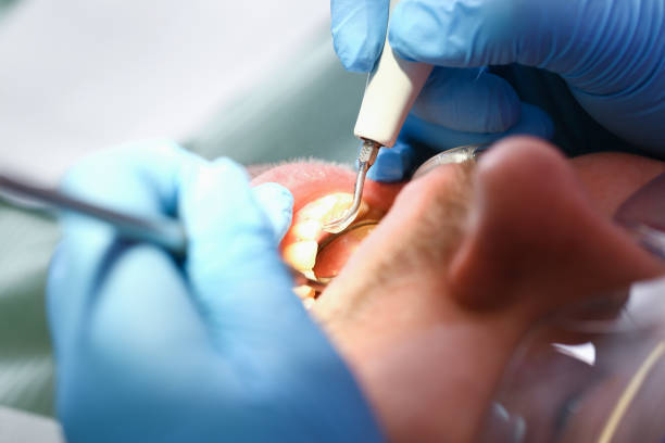 Best Emergency Treatment for Dental Infections or Abscesses in North Massapequa, NY